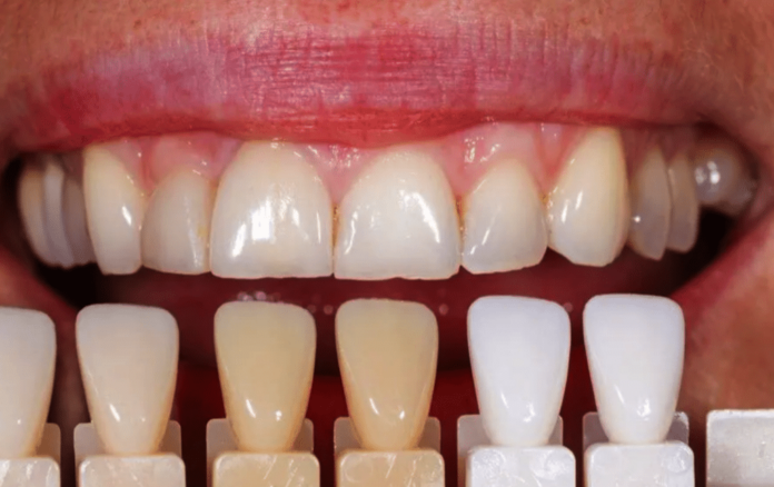 El 40% de la población se acompleja de su sonrisa por no poder blanquearse los dientes