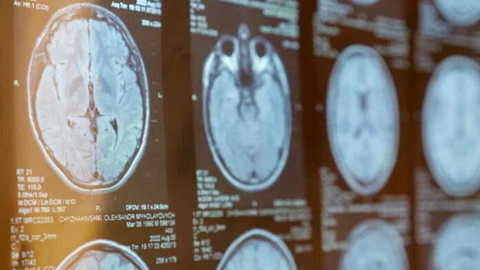 Imagen resonancia magnética cerebro