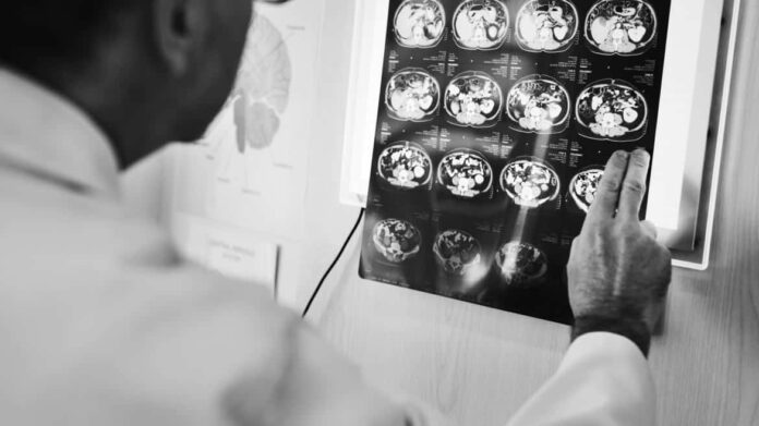 Doctor viendo análisis de paciente con Epilepsia