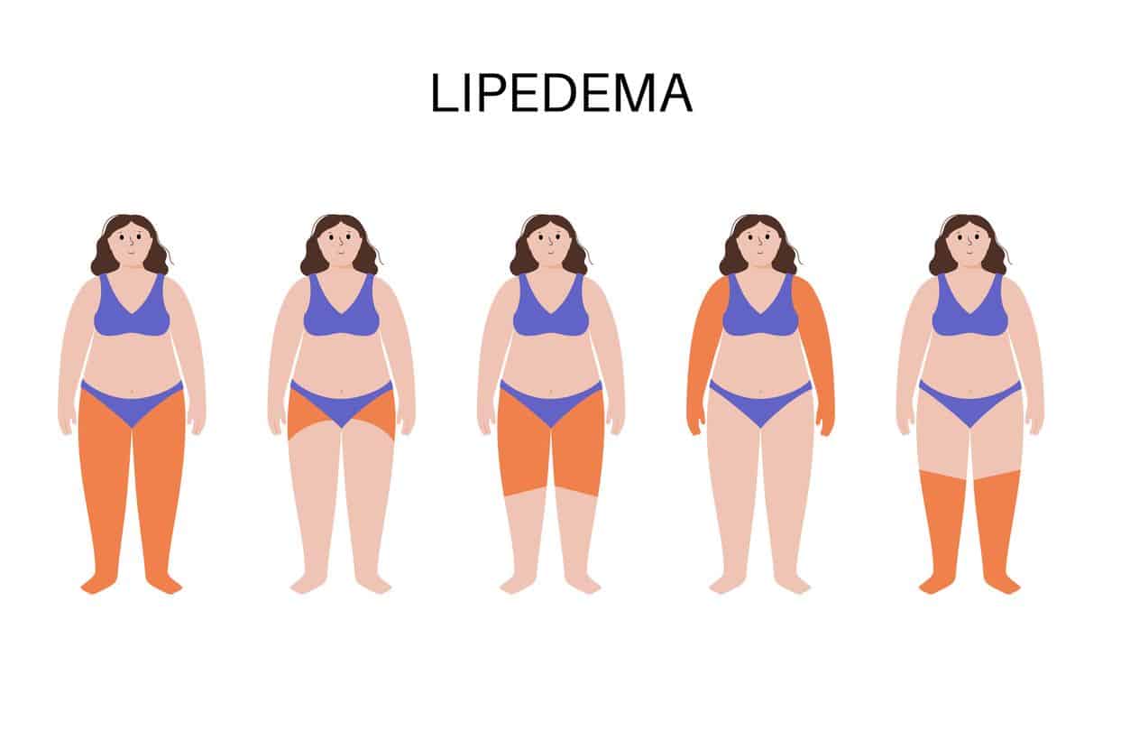 Lipedema: Superando el Dolor y las Limitaciones en el Camino de las Mujeres