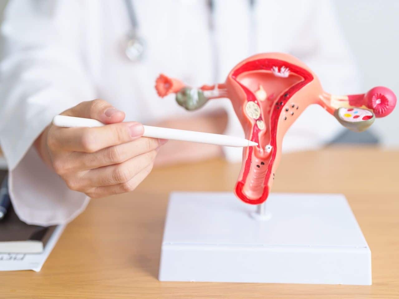 Endometriosis: El Trastorno Silencioso que Transforma Vidas