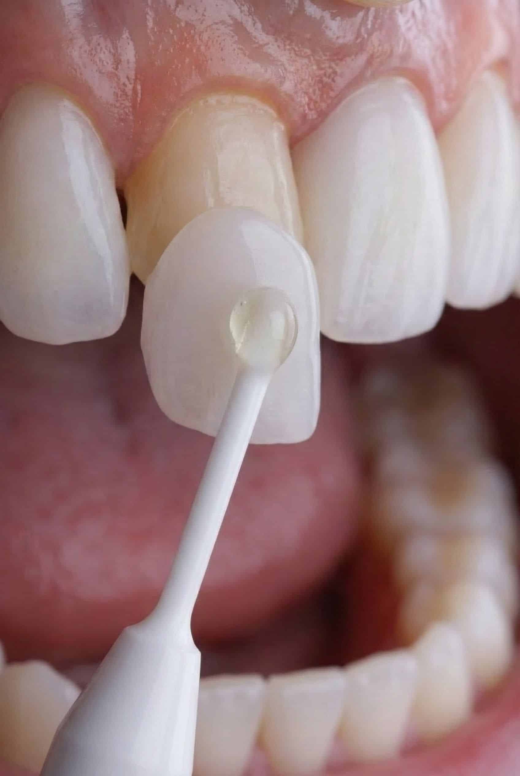 Instituto Volpe Revoluciona la Odontología Estética con Skin Finea®: Carillas Ultrafinas que Conservan la Integridad Dental
