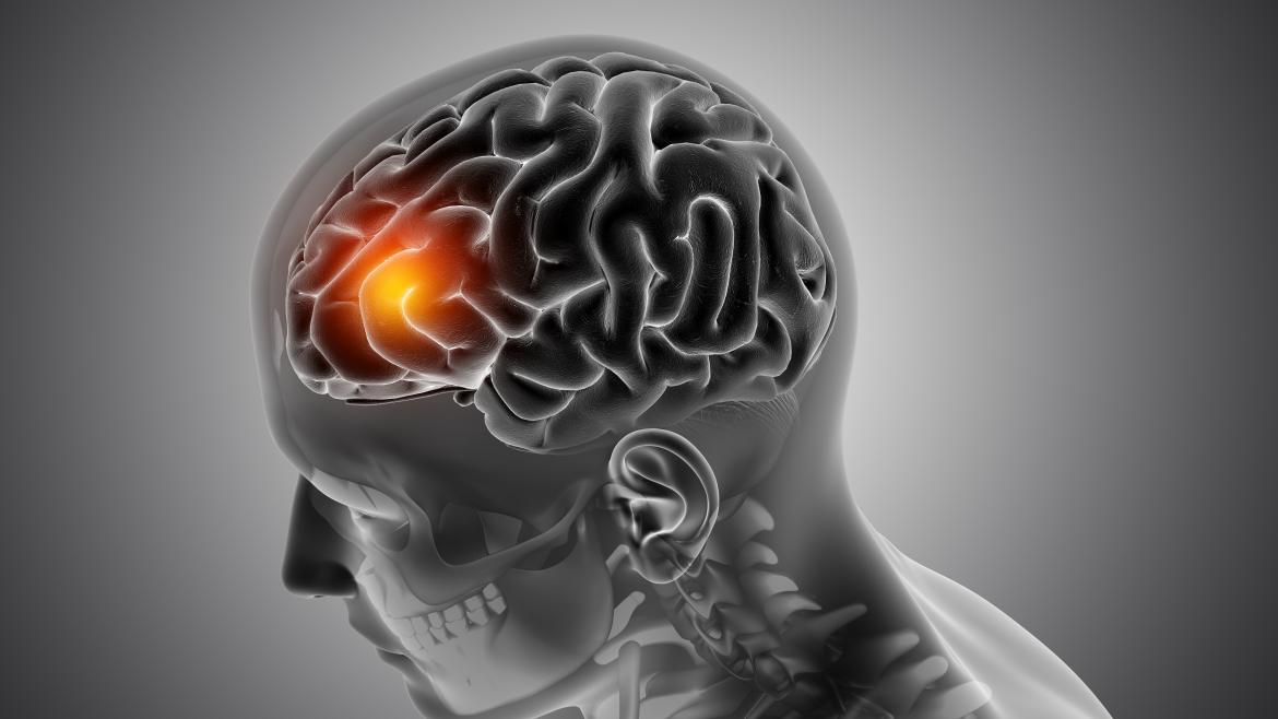 Descubrimiento de una Variante Genética Relevante para el Parkinson en el Hospital Fundación Alcorcón
