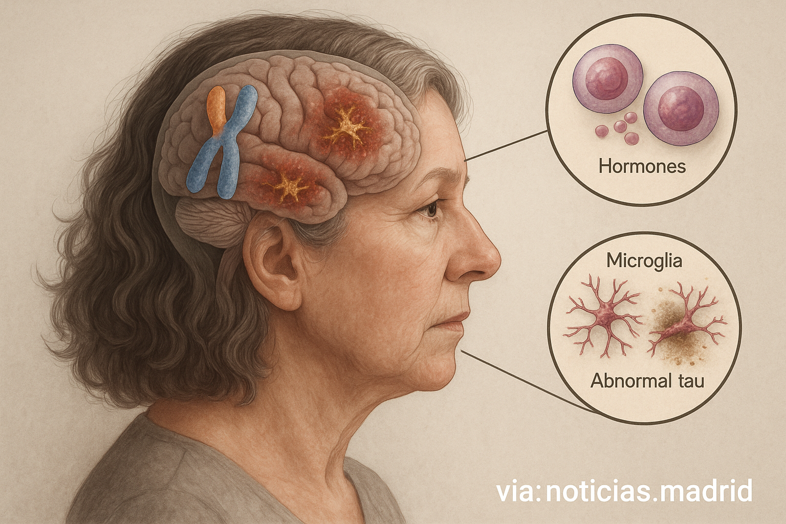 Mecanismos biológicos que explican la acelerada progresión del Alzheimer en mujeres